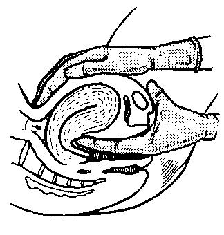 Pear-shaped uterus is felt during an exam.  Fingertips are at the junction of the cervix to the fundus.